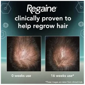 فوم ماینوکسیدل %5 مناسب آقایان برند ریگین regaine
