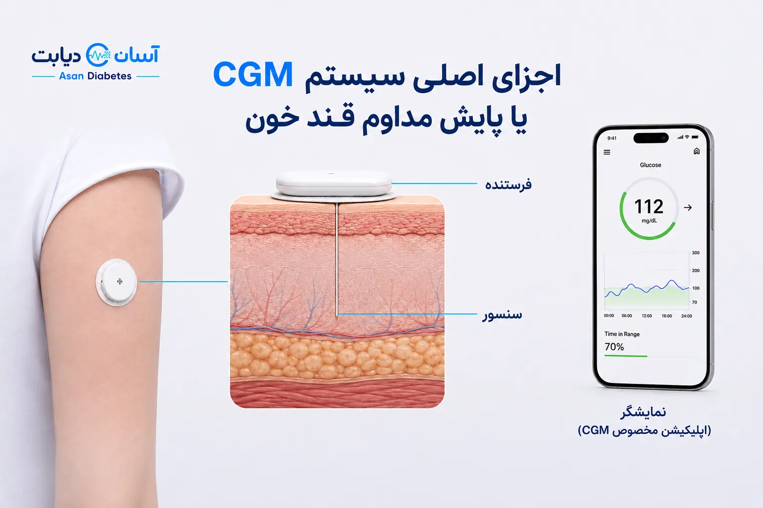 اجزای سنسور مدوام پایش قند خون