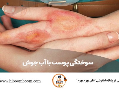 🏠 درمان سوختگی با آب جوش و بخار | راهنمای کامل کمکهای اولیه در خانه