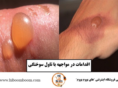 💥 درمان تاول سوختگی | آیا باید تاول را ترکاند یا نه؟