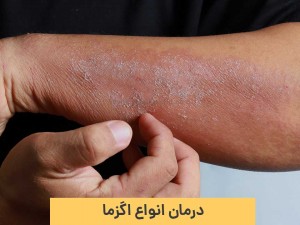 15 روش‌ درمان اگزما