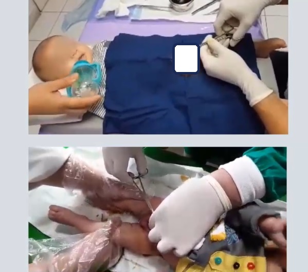 ویدئوی فیکس نگه داشتن شیرخوار در زمان ختنه با تخت ختنه و با روش سنتی
