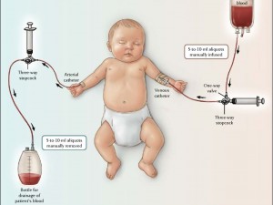 تعویض خون (Exchange Transfusion) یکی از فرآیندهای حیاتی و پیچیده در پزشکی نوزادان است که معمولاً برای درمان شرایط خطیری مانند: زردی شدید نوزادان (هیپربیلیروبینمی)،ناسازگاری خون مادر و نوزاد (مثلاً Rh یا ABO incompatibility) استفاده می‌شود. در این روش، خون