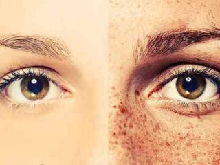 ملاسما و محو کردن لکه های قهوه ای پوست
