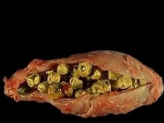 علائم سنگ کیسه صفرا +راهکارهای درمان