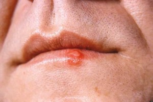 راهکار جلوگیری از انتشار تبخال (مطلب)