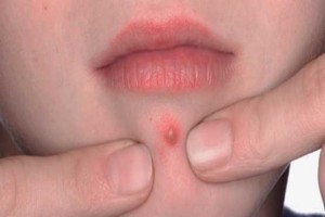 آشنایی با عواقب کندن جوش