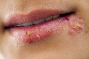 علت تبخال چیست؟ (مطلب)