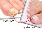 3 درمان خانگی برای قارچ ناخن