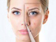 اصول زیبایی برای پوست های جوش دار!