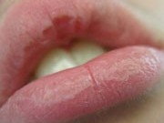 علت خشکی ترک و پوسته شدن لب ‌ها