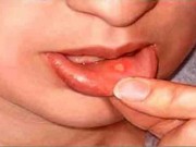 داروی طبیعی برای آفت دهان (مطلب)