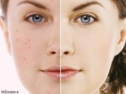 ۸ ماسک طبیعی و خانگی برای درمان جوش صورت (مطلب)