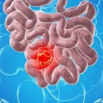 چگونه متوجه شویم که روده هایمان مشکل دارد ؟