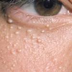 دانه های سفید زیر چشم علل و درمان (مطلب)