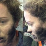 سوختگی صورت دختر جوان در اثر انفجار باتری