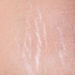 چگونه ترک شکم پس از بارداری را از بین ببریم؟