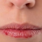 معرفی علائم و دلایل ایجاد اگزمای لب