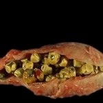 علائم سنگ کیسه صفرا +راهکارهای درمان