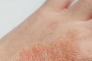 با این ۶ ماده غذایی به جنگ اگزمای پوستی بروید
