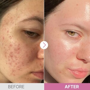 سرم نیاسینامید 15% کوزارکس 20ml