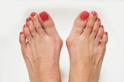 حل مشکل انحراف شست پا (Hallux Valgus)
