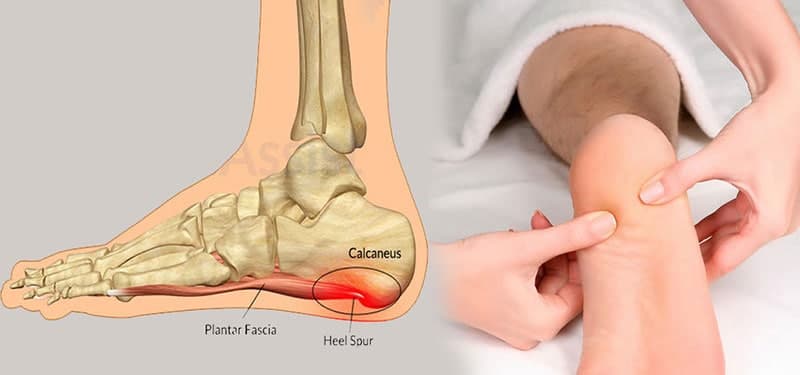 خار پاشنه چیست و چه درمانی دارد؟