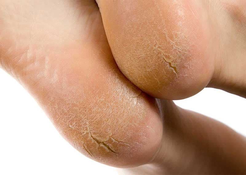 چرا کف پا ترک می خورد؟