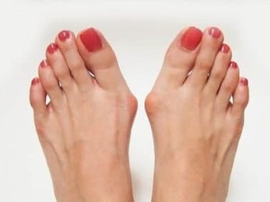 حل مشکل انحراف شست پا (Hallux Valgus)