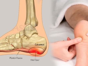 خار پاشنه چیست و چه درمانی دارد؟