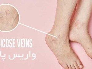 واریس پا چیست؟ علائم و راه های درمان واریس پا