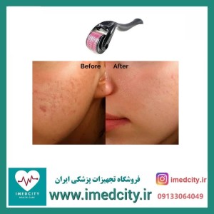 درمارولر (میکرونیدلینگ خانگی دستی )