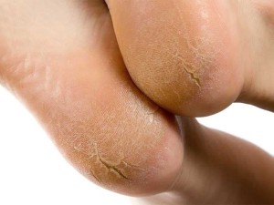 چرا کف پا ترک می خورد؟