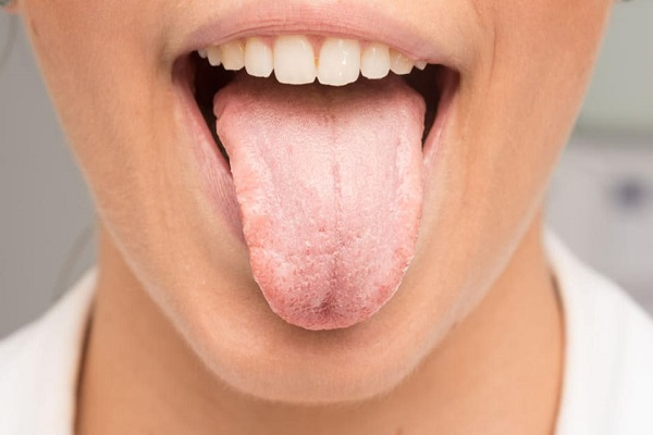 کمبود کدام ویتامین باعث خشکی دهان میشود؟