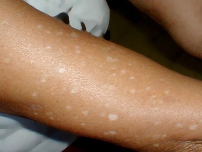 بررسی کامل رابطه لکه های سفید روی پوست و کمبود ویتامین