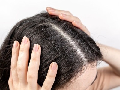 کمبود کدام ویتامین باعث خشکی پوست سر میشود؟