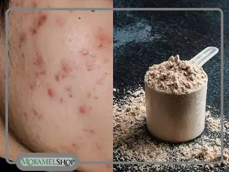 آیا مکمل&zwnj; های بدنسازی باعث جوش می&zwnj; شود؟