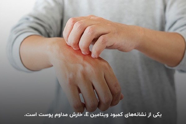 استفاده از مکمل ویتامین E برای رفع خارشهای پوستی