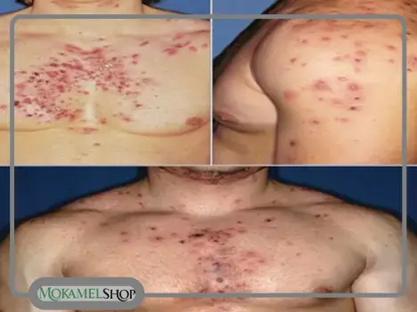 جوش ناشی از مصرف مکمل بدنسازی