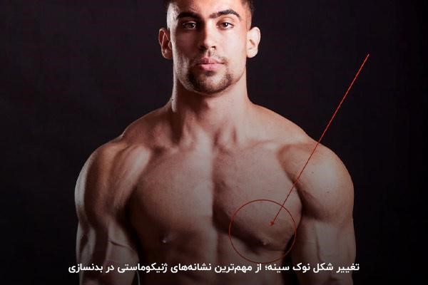 بررسی نشانه&zwnj;ها و علائم ژنیکوماستی بدنسازان