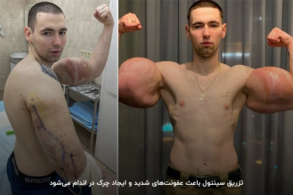 عفونت و خون&zwnj;ریزی داخلی؛&zwnj; از عوارض شدید سینتول