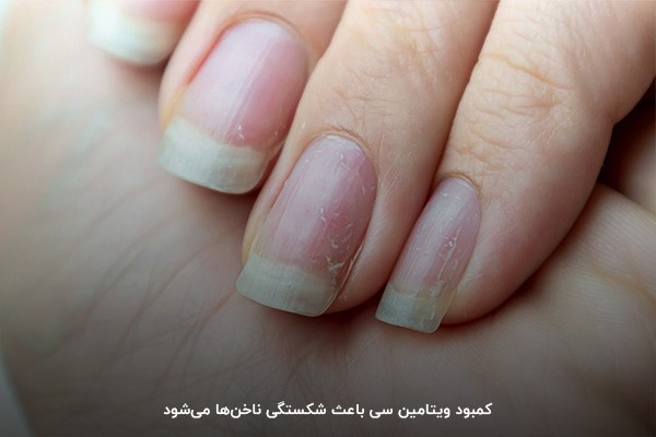 تغییر شکل ناخن؛ بر اثر کمبود ویتامین سی