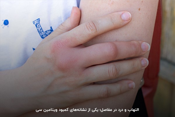 کمبود ویتامین سی؛ عامل ایجاد کبودی عمیق بر اثر ضربات سطحی