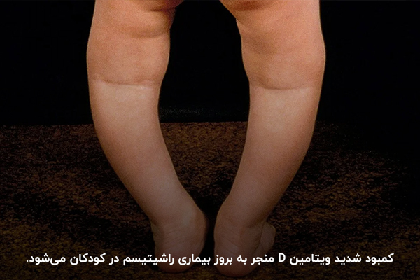 بیماری راشیتیسم؛ عوارض کمبود ویتامین دی در کودکان