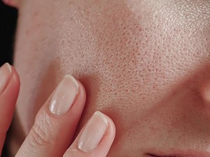 آیا منافذ باز روی پوست صورت خود دارید؟ با راه های خلاص شدن از شر آنها آشنا شوید (مطلب)
