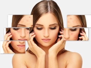 آکنه چیست؟ همه آنچه که باید در مورد جوش های سرسخت بدانید (مطلب)
