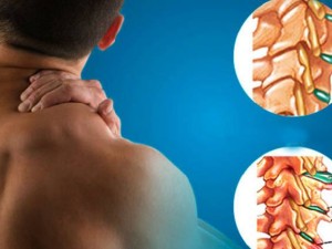 اسپوندیلوز؛ علائم، تشخیص و درمان