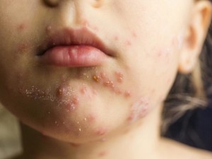 10 نوع رایج بثورات پوستی و علائم آن‌ها