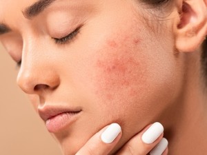 چطور پوست تحریک‌شده و ملتهب را به حالت عادی بازگردانیم؟