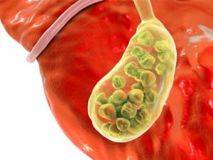 علائم شایع سنگ کیسه صفرا